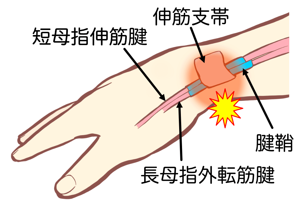 腱鞘炎の病態図